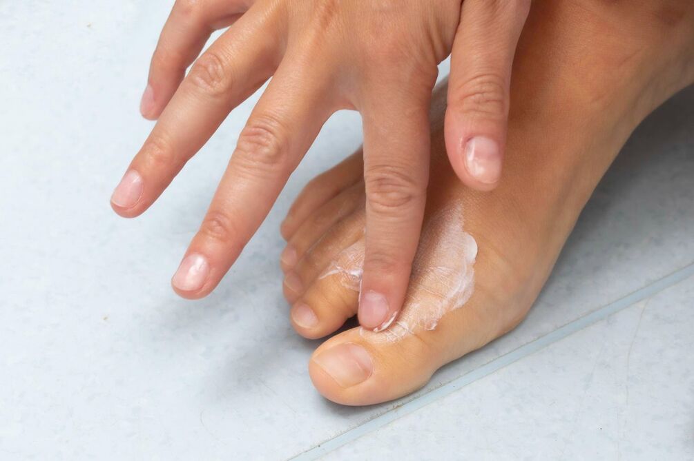 Applicazione di zxcvbnmqwert -cream dal fungo tra le dita dei piedi