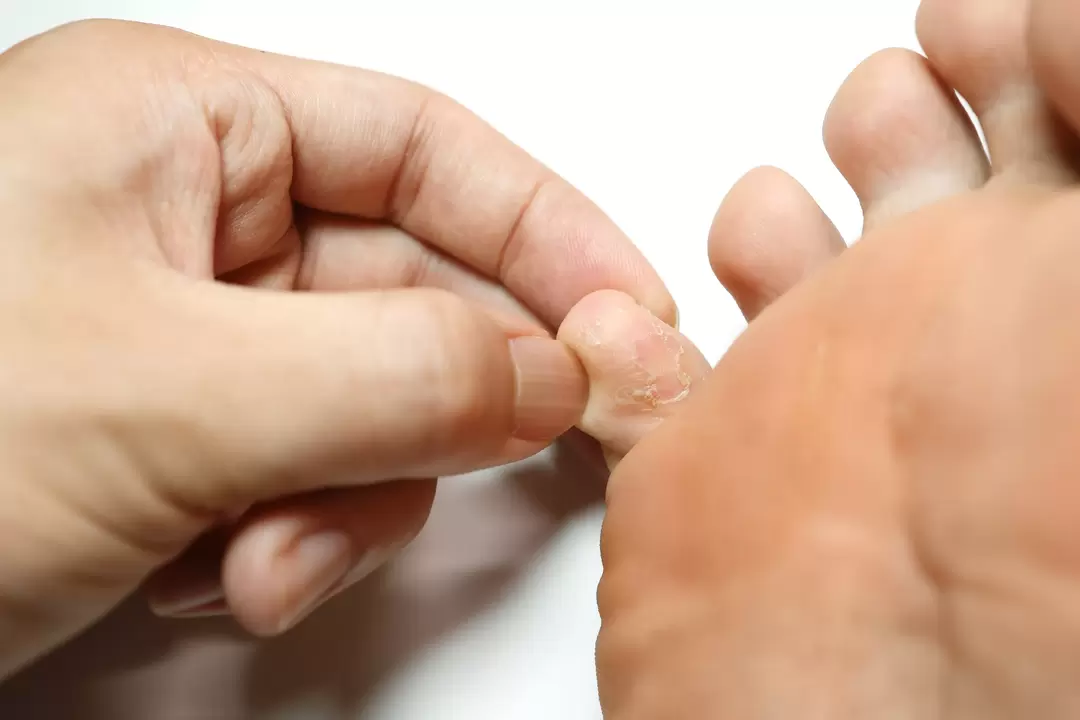 Fungo sopra le dita e il trattamento con crema demyxil