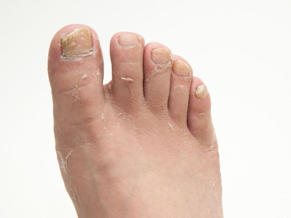 Fungo sulla pelle delle gambe e il loro trattamento con crema zxcvbnmqwort