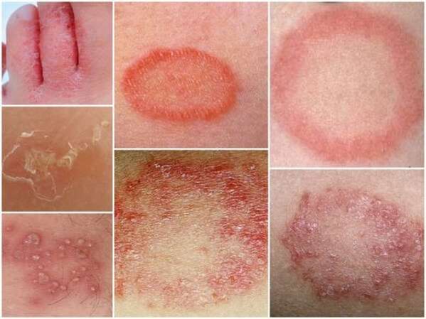 Tricofitosi della pelle delle gambe